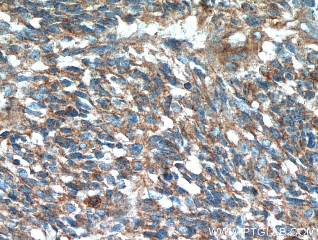 IHC staining of human gliomas using 11250-1-AP