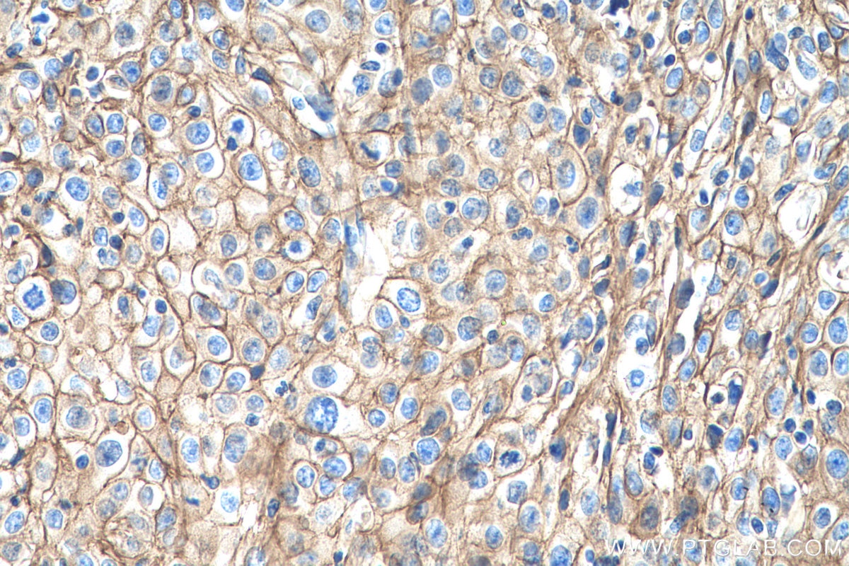 Immunohistochemistry (IHC) staining of human cervical cancer tissue using S100A10 Monoclonal antibody (66227-1-Ig)