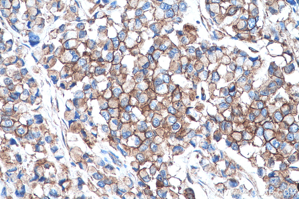 Immunohistochemistry (IHC) staining of human colon cancer tissue using S100A10 Monoclonal antibody (66227-1-Ig)