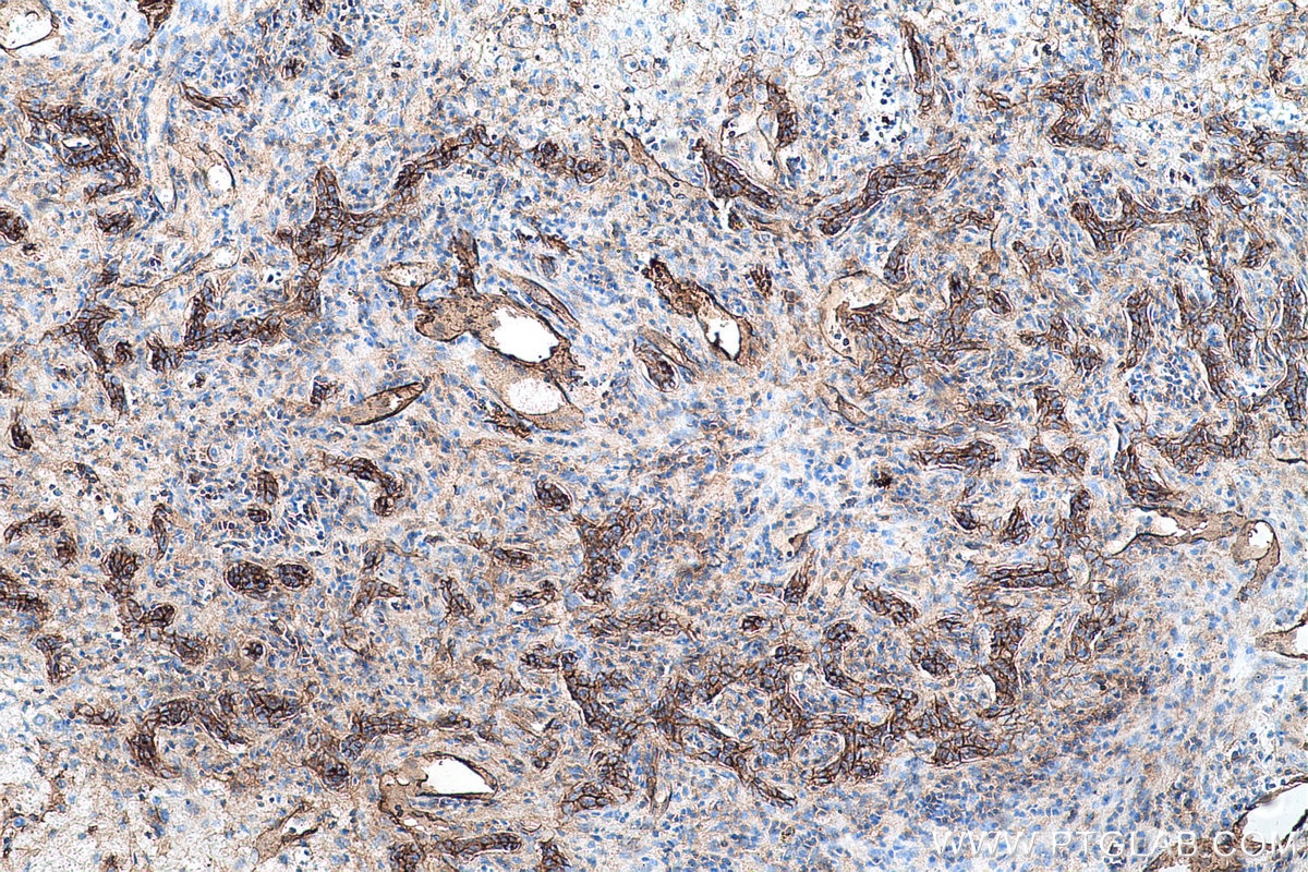 Immunohistochemistry (IHC) staining of human liver cancer tissue using S100A10 Monoclonal antibody (66227-1-Ig)