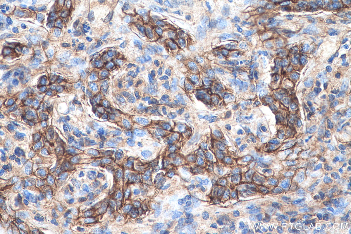 Immunohistochemistry (IHC) staining of human liver cancer tissue using S100A10 Monoclonal antibody (66227-1-Ig)