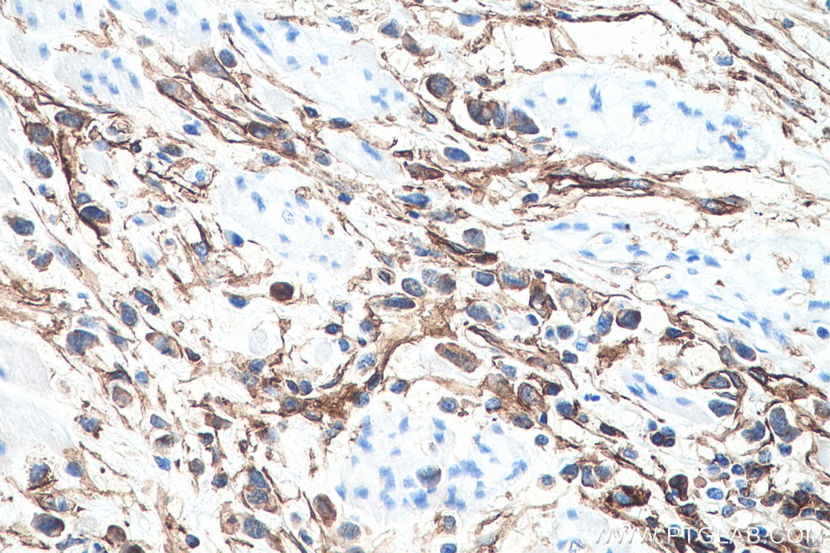 Immunohistochemistry (IHC) staining of human stomach cancer tissue using S100A10 Monoclonal antibody (66227-1-Ig)