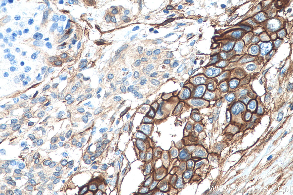 Immunohistochemistry (IHC) staining of human pancreas cancer tissue using S100A10 Monoclonal antibody (66227-1-Ig)