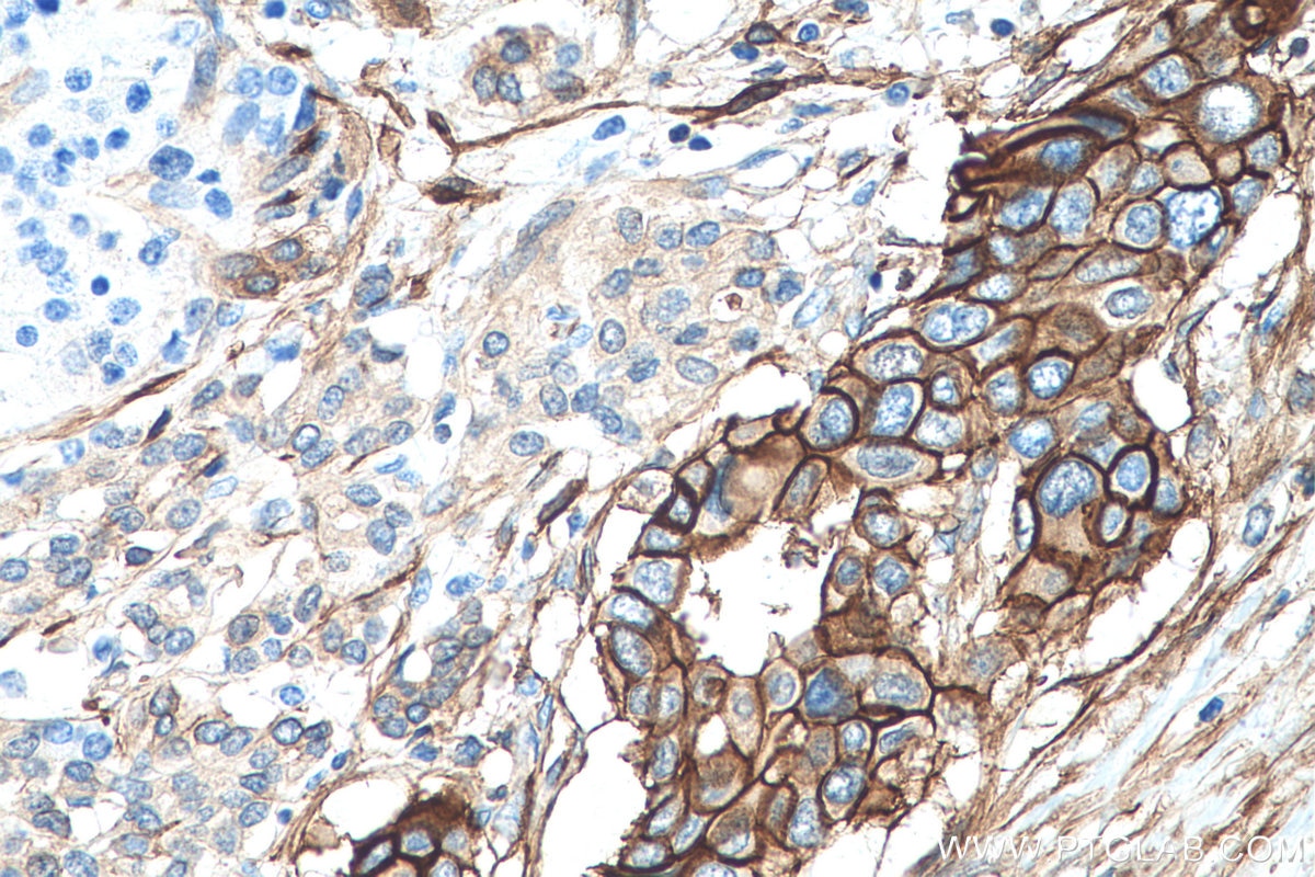 Immunohistochemistry (IHC) staining of human pancreas cancer tissue using S100A10 Monoclonal antibody (66227-1-Ig)