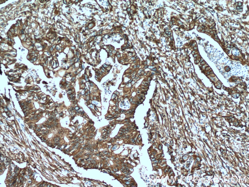 IHC staining of human pancreas cancer using 66227-1-Ig