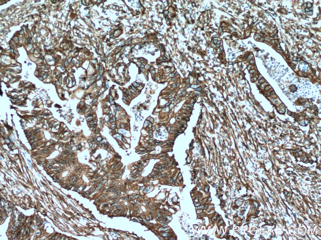 Immunohistochemistry (IHC) staining of human pancreas cancer tissue using S100A10 Monoclonal antibody (66227-1-Ig)