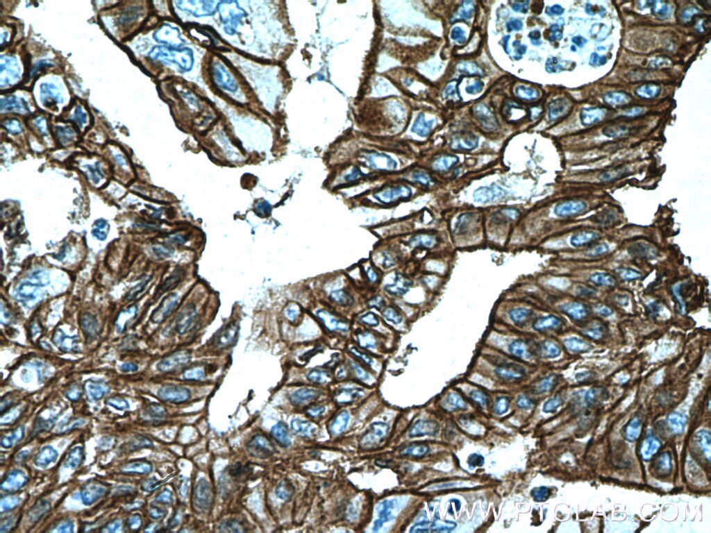 Immunohistochemistry (IHC) staining of human pancreas cancer tissue using S100A10 Monoclonal antibody (66227-1-Ig)