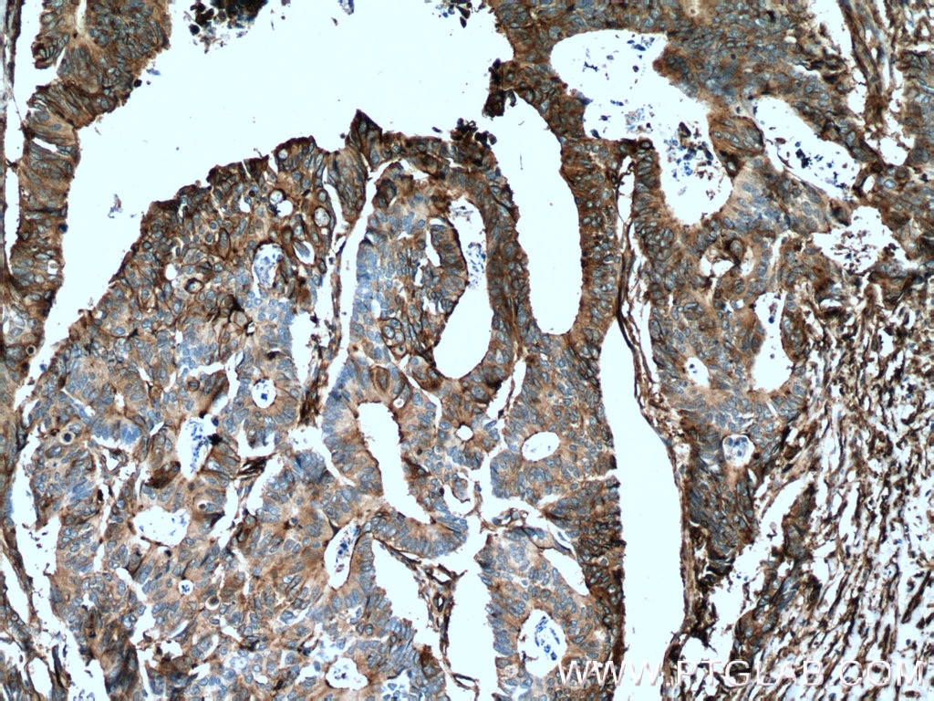 IHC staining of human colon cancer using 66227-1-Ig
