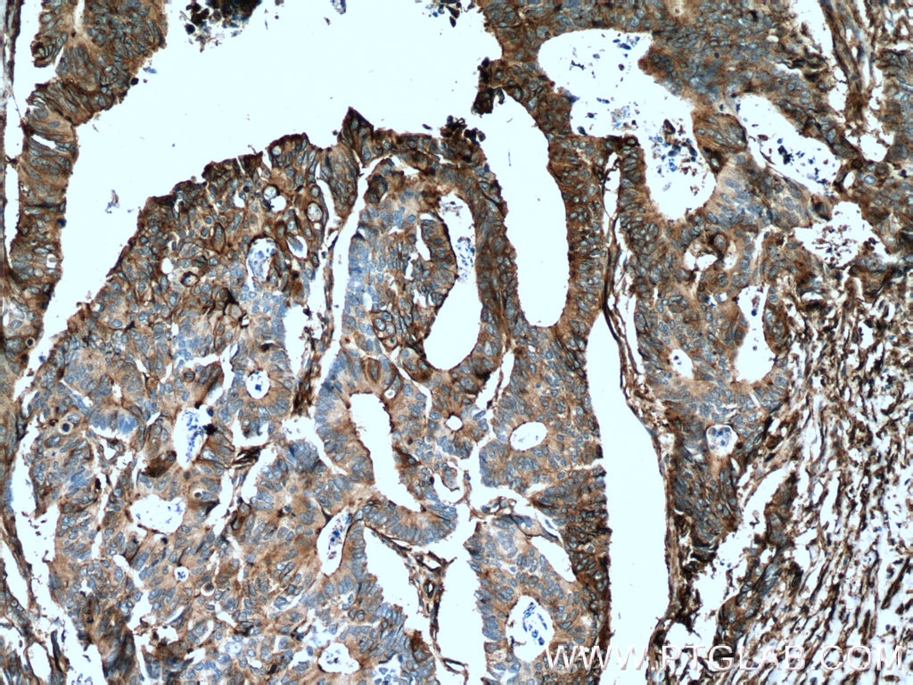 Immunohistochemistry (IHC) staining of human colon cancer tissue using S100A10 Monoclonal antibody (66227-1-Ig)