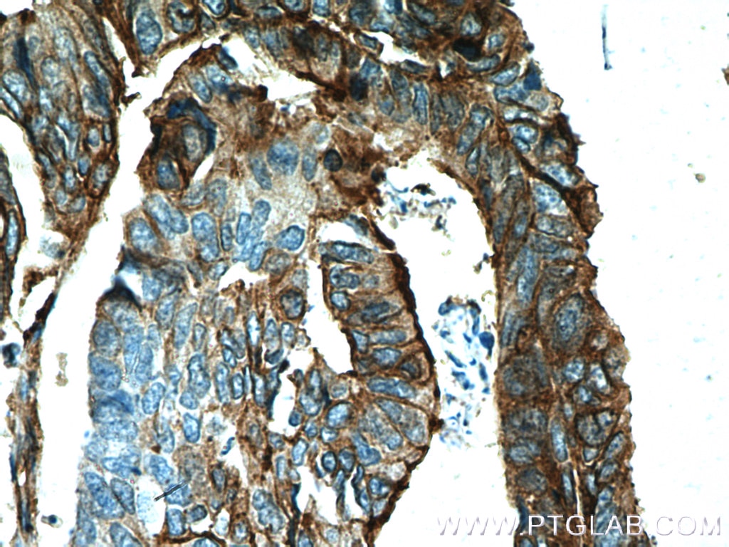 Immunohistochemistry (IHC) staining of human colon cancer tissue using S100A10 Monoclonal antibody (66227-1-Ig)