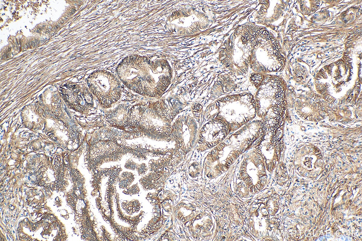 Immunohistochemistry (IHC) staining of human pancreas cancer tissue using S100A10 Recombinant antibody (81017-1-RR)