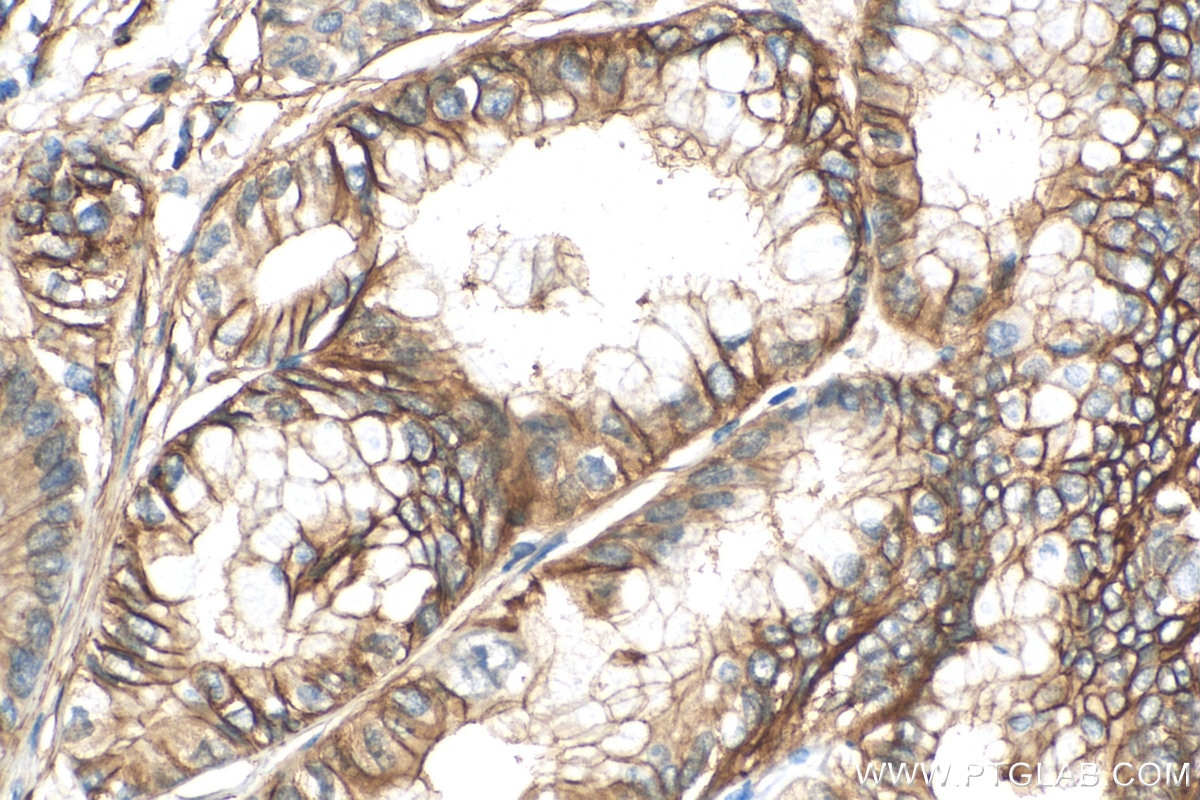 Immunohistochemistry (IHC) staining of human pancreas cancer tissue using S100A10 Recombinant antibody (81017-1-RR)