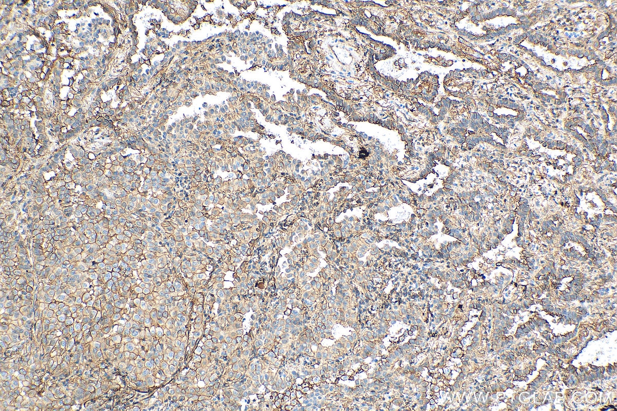 Immunohistochemistry (IHC) staining of human lung cancer tissue using S100A10 Recombinant antibody (81017-1-RR)