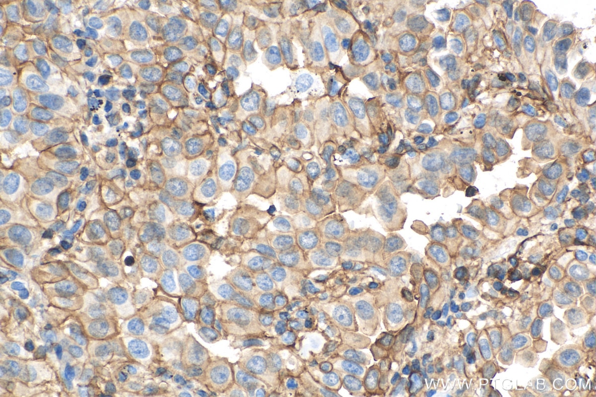 Immunohistochemistry (IHC) staining of human lung cancer tissue using S100A10 Recombinant antibody (81017-1-RR)