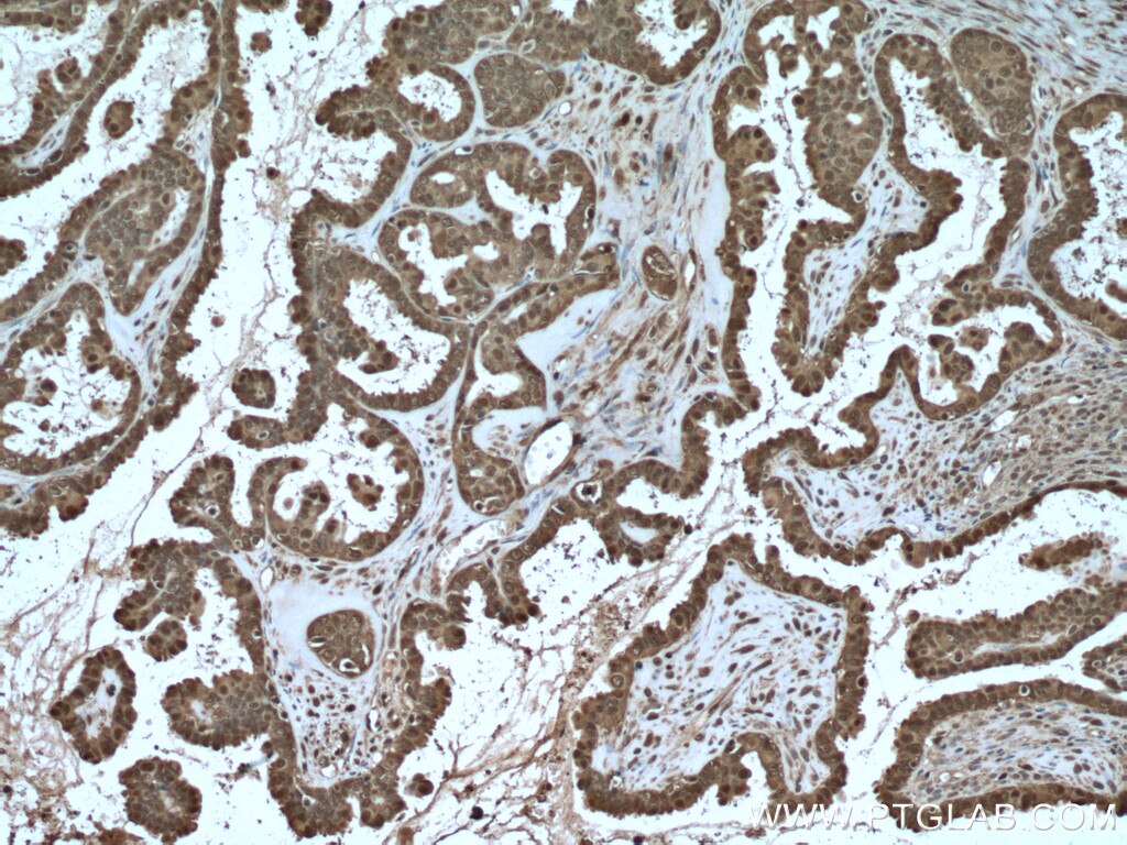 Immunohistochemistry (IHC) staining of human ovary tumor tissue using S100A11 Polyclonal antibody (10237-1-AP)