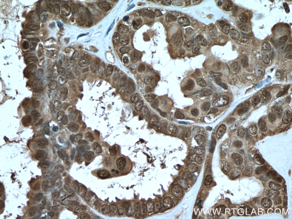 Immunohistochemistry (IHC) staining of human ovary tumor tissue using S100A11 Polyclonal antibody (10237-1-AP)