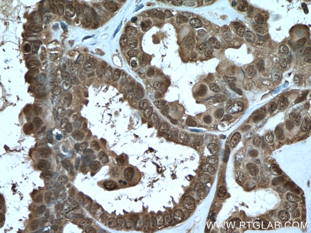 IHC staining of human ovary tumor using 10237-1-AP