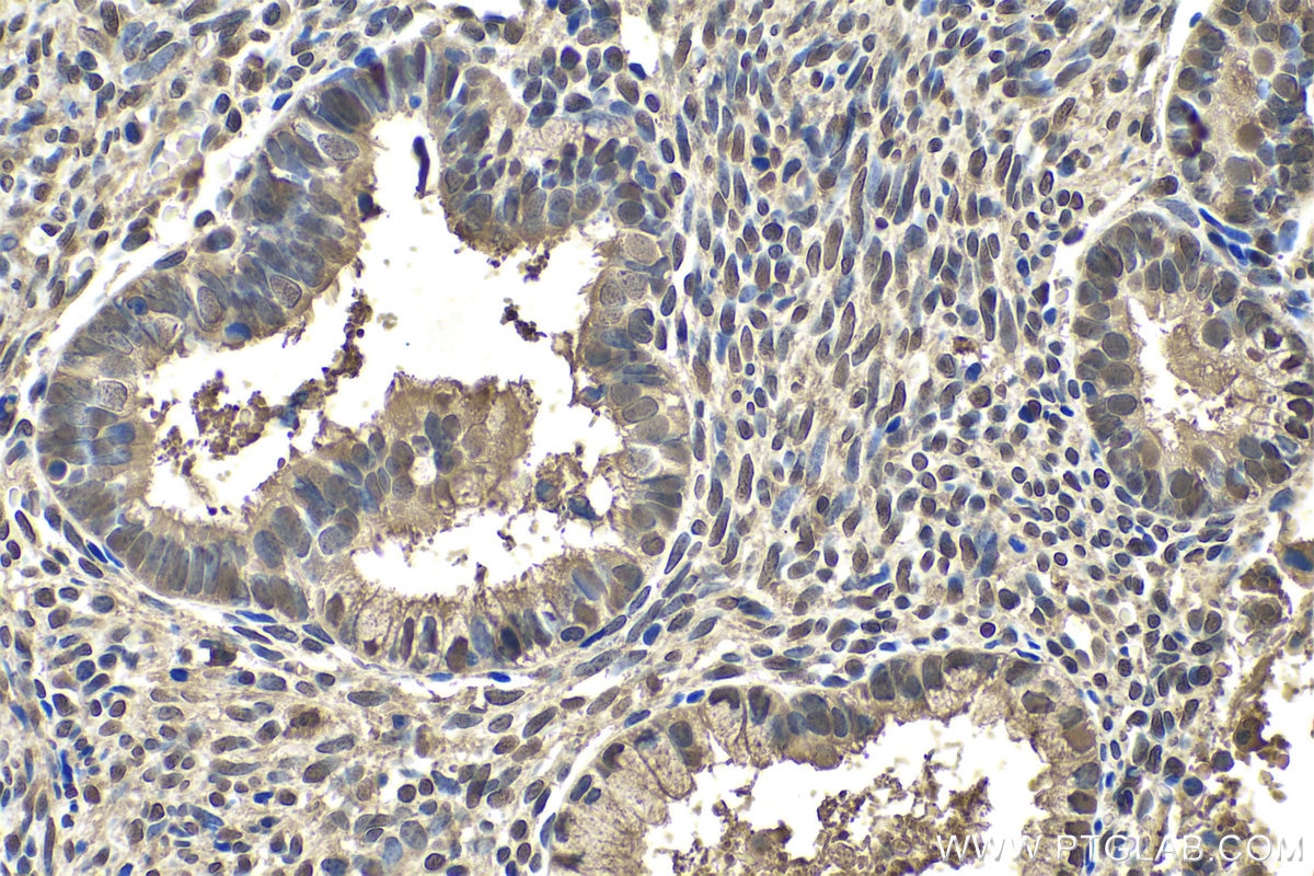Immunohistochemistry (IHC) staining of human cervical cancer tissue using S100A11 Polyclonal antibody (10237-1-AP)