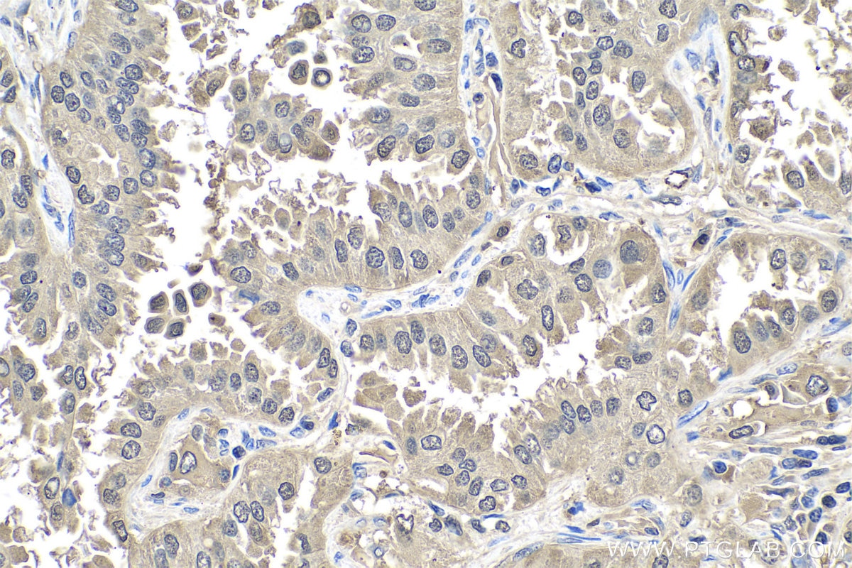 Immunohistochemistry (IHC) staining of human lung cancer tissue using S100A11 Polyclonal antibody (10237-1-AP)