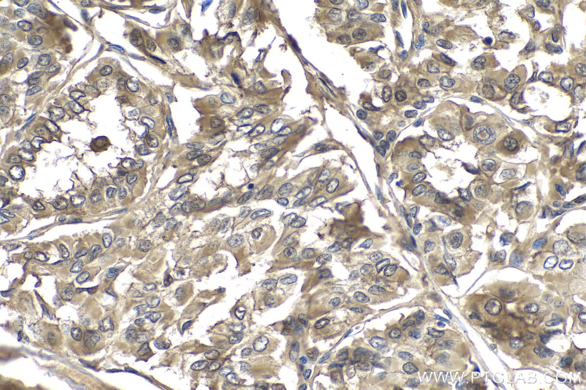 Immunohistochemistry (IHC) staining of human thyroid cancer tissue using S100A11 Polyclonal antibody (10237-1-AP)