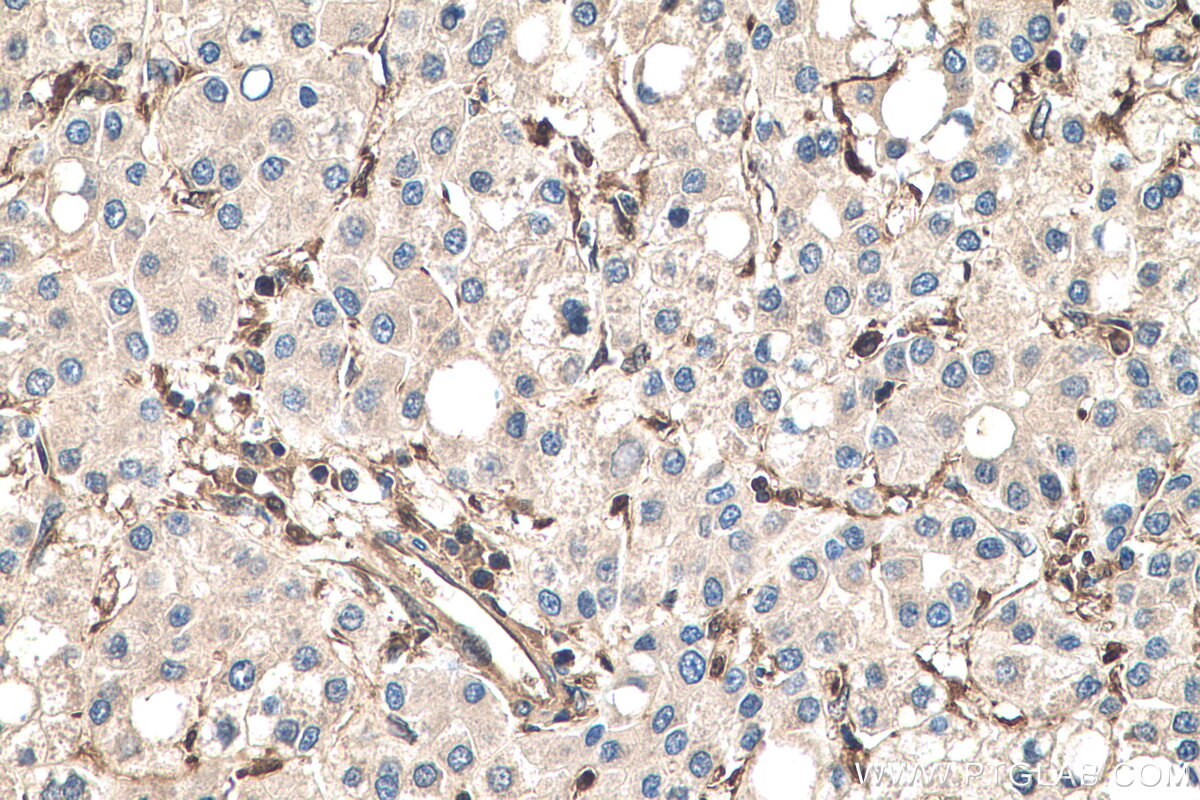Immunohistochemistry (IHC) staining of human liver cancer tissue using S100A11 Polyclonal antibody (10237-1-AP)