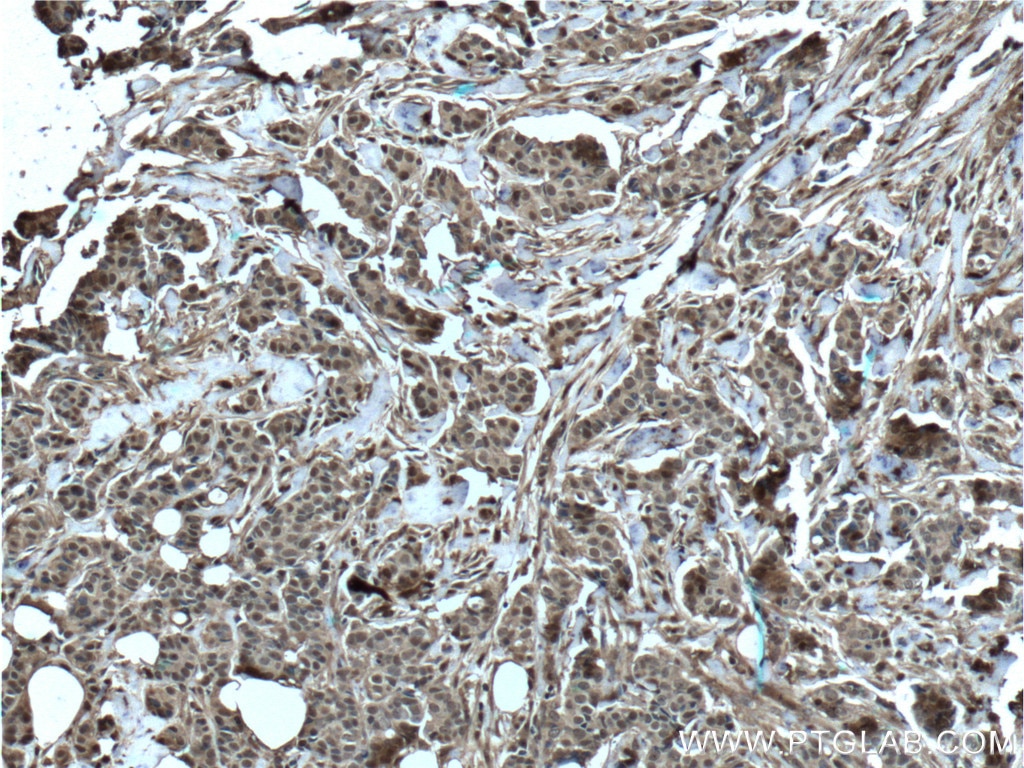 Immunohistochemistry (IHC) staining of human breast cancer tissue using S100A11 Polyclonal antibody (10237-1-AP)
