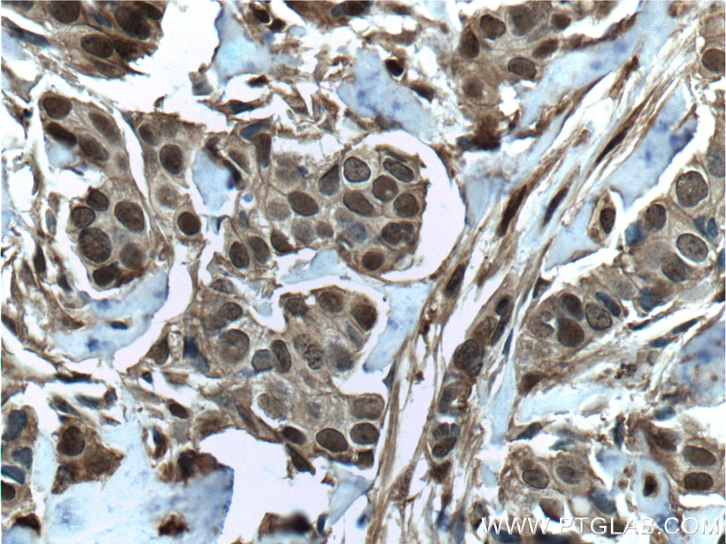 Immunohistochemistry (IHC) staining of human breast cancer tissue using S100A11 Polyclonal antibody (10237-1-AP)