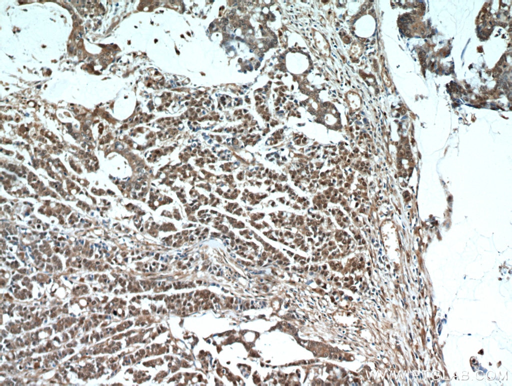 Immunohistochemistry (IHC) staining of human colon cancer tissue using S100A11 Polyclonal antibody (10237-1-AP)
