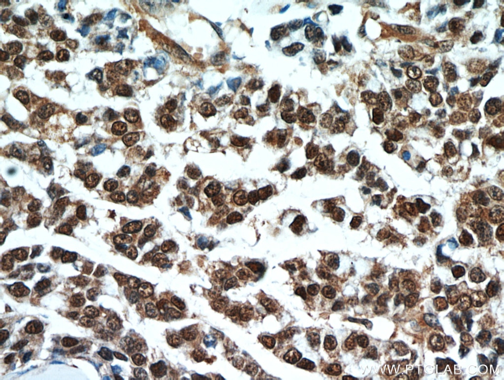 IHC staining of human colon cancer using 10237-1-AP
