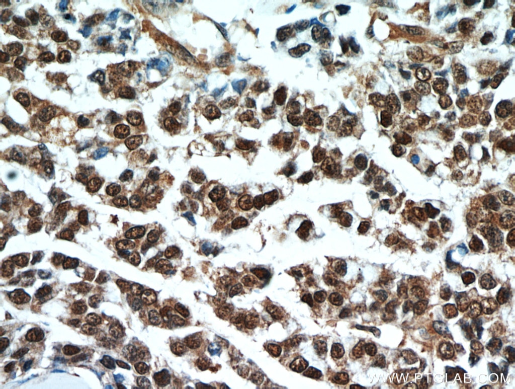 Immunohistochemistry (IHC) staining of human colon cancer tissue using S100A11 Polyclonal antibody (10237-1-AP)