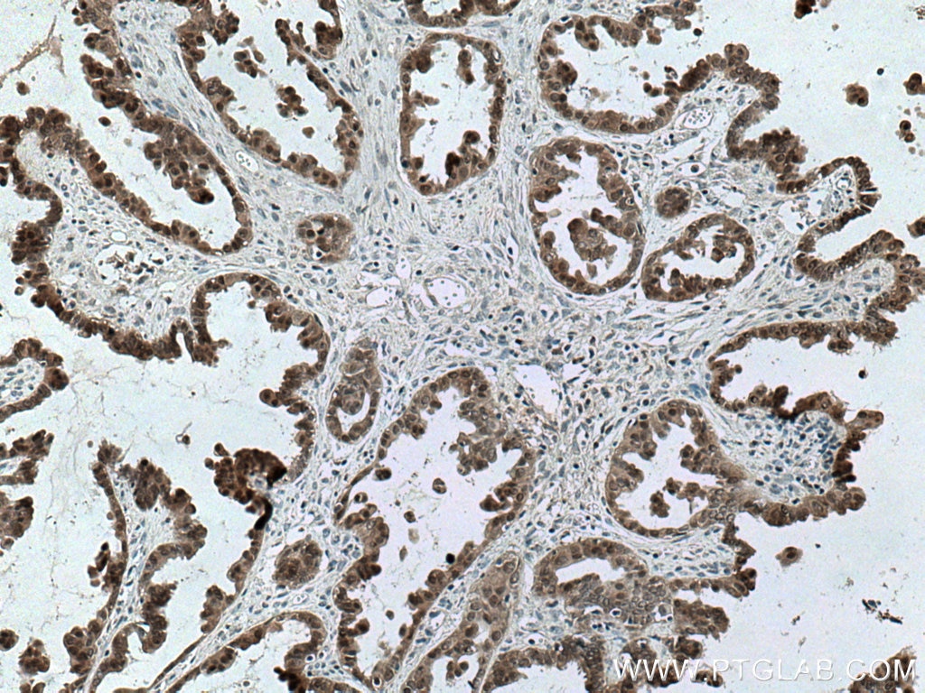 Immunohistochemistry (IHC) staining of human ovary tumor tissue using S100A11 Monoclonal antibody (60024-1-Ig)