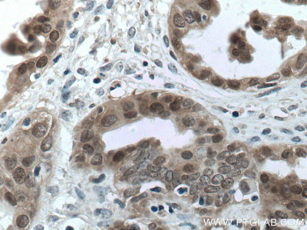 Immunohistochemistry (IHC) staining of human ovary tumor tissue using S100A11 Monoclonal antibody (60024-1-Ig)