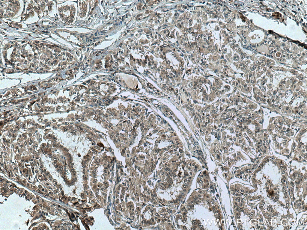 Immunohistochemistry (IHC) staining of human thyroid cancer tissue using S100A11 Monoclonal antibody (60024-1-Ig)