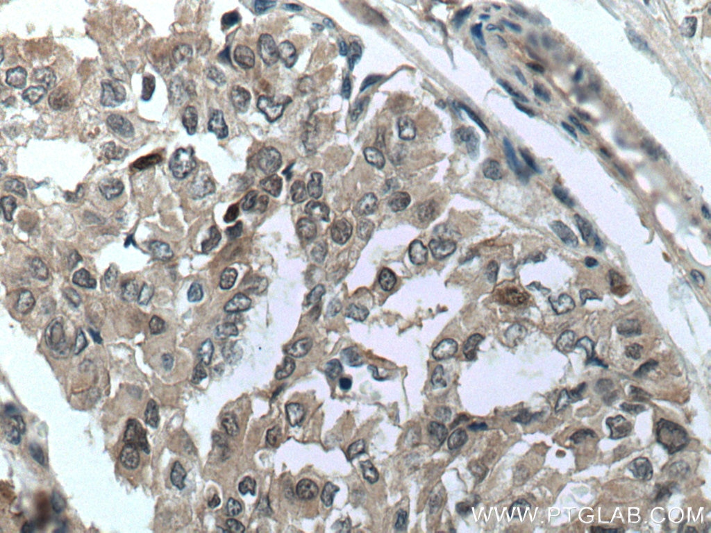 Immunohistochemistry (IHC) staining of human thyroid cancer tissue using S100A11 Monoclonal antibody (60024-1-Ig)