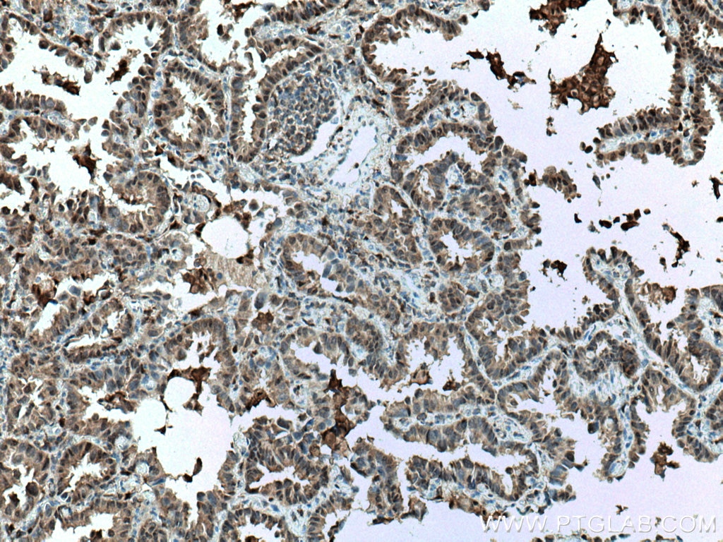Immunohistochemistry (IHC) staining of human lung cancer tissue using S100A11 Monoclonal antibody (60024-1-Ig)