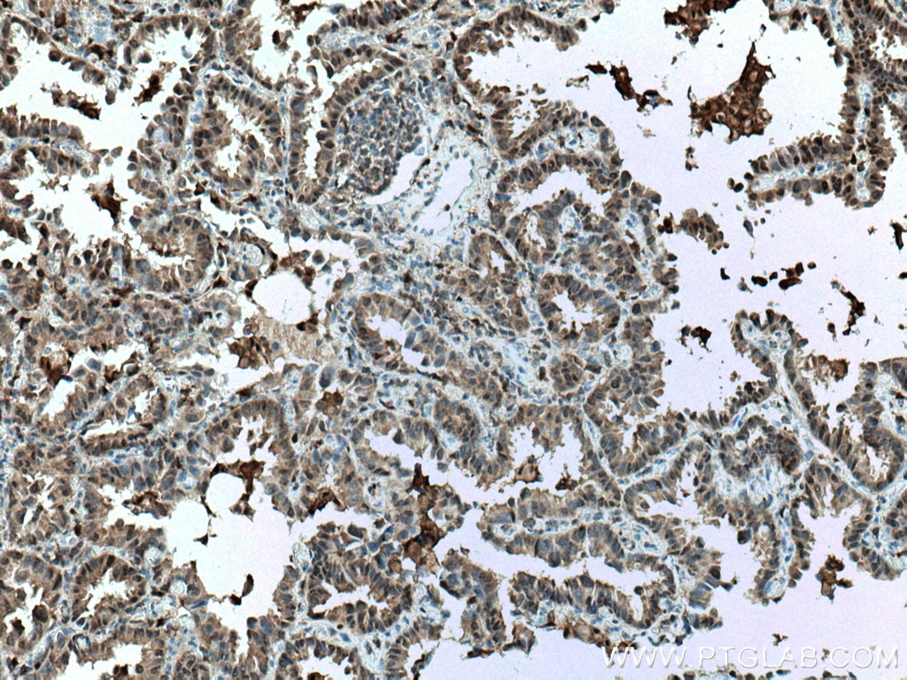 IHC staining of human lung cancer using 60024-1-Ig