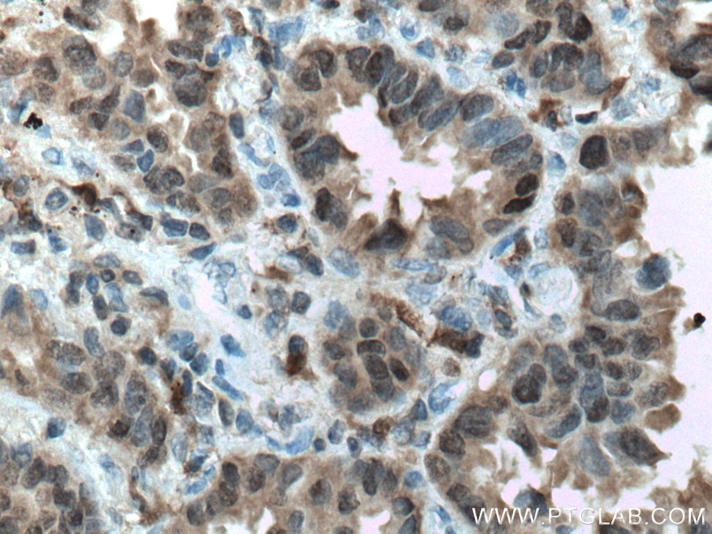 Immunohistochemistry (IHC) staining of human lung cancer tissue using S100A11 Monoclonal antibody (60024-1-Ig)