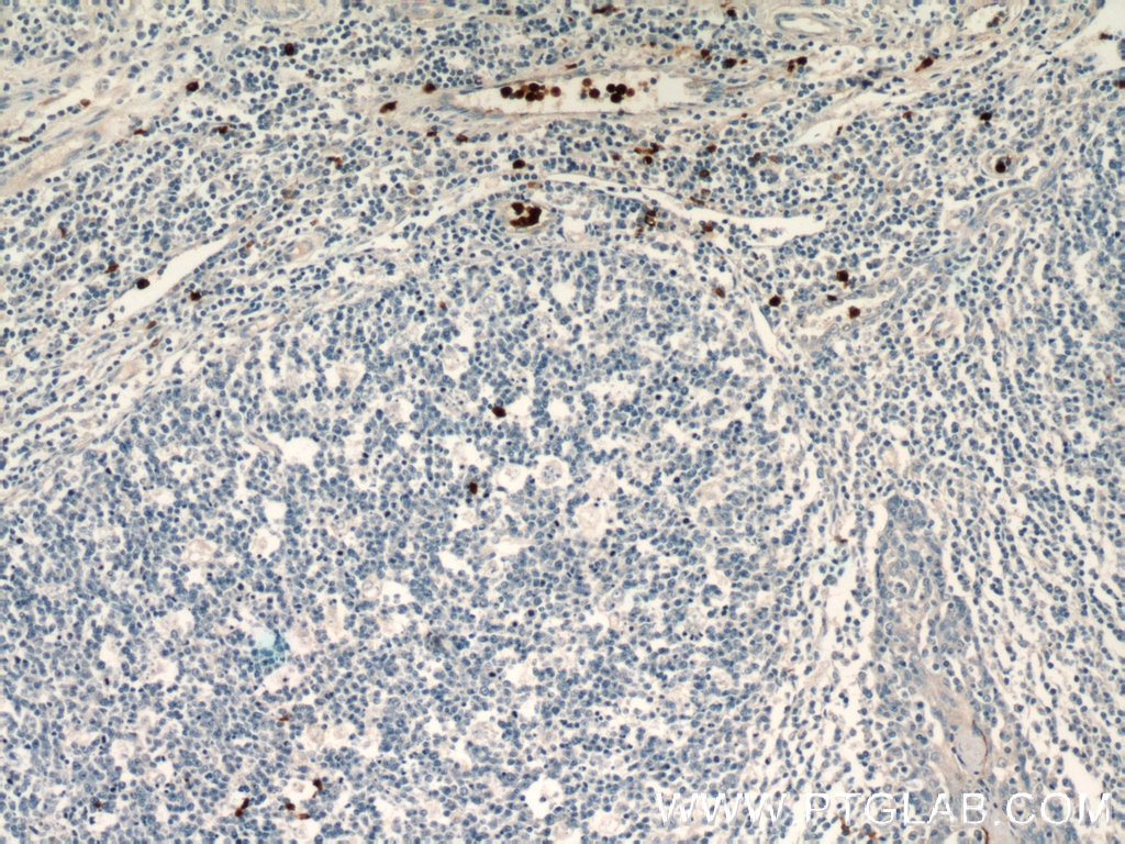 Immunohistochemistry (IHC) staining of human tonsillitis tissue using S100A12 Polyclonal antibody (16630-1-AP)
