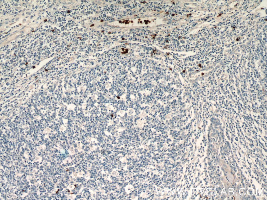 IHC staining of human tonsillitis using 16630-1-AP