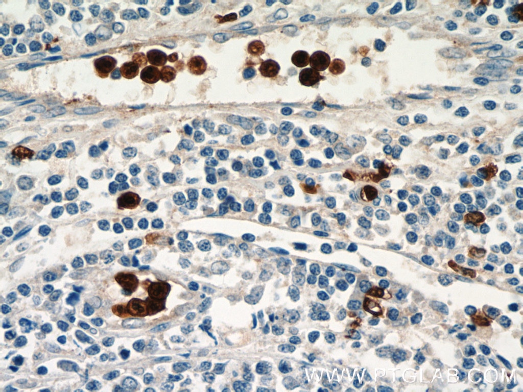 Immunohistochemistry (IHC) staining of human tonsillitis tissue using S100A12 Polyclonal antibody (16630-1-AP)