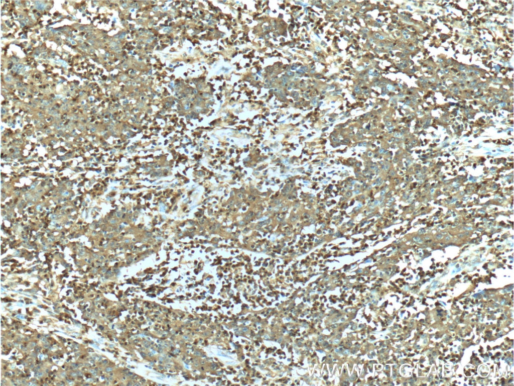 Immunohistochemistry (IHC) staining of human colon cancer tissue using S100A12 Polyclonal antibody (16630-1-AP)