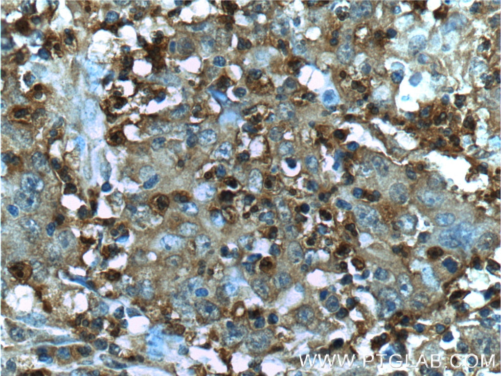 Immunohistochemistry (IHC) staining of human colon cancer tissue using S100A12 Polyclonal antibody (16630-1-AP)