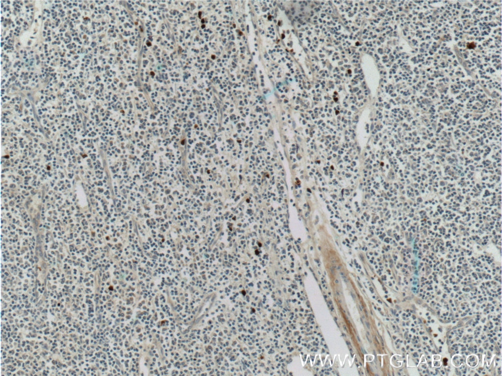 Immunohistochemistry (IHC) staining of human tonsillitis tissue using S100A12 Polyclonal antibody (16630-1-AP)