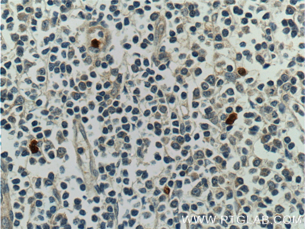 Immunohistochemistry (IHC) staining of human tonsillitis tissue using S100A12 Polyclonal antibody (16630-1-AP)