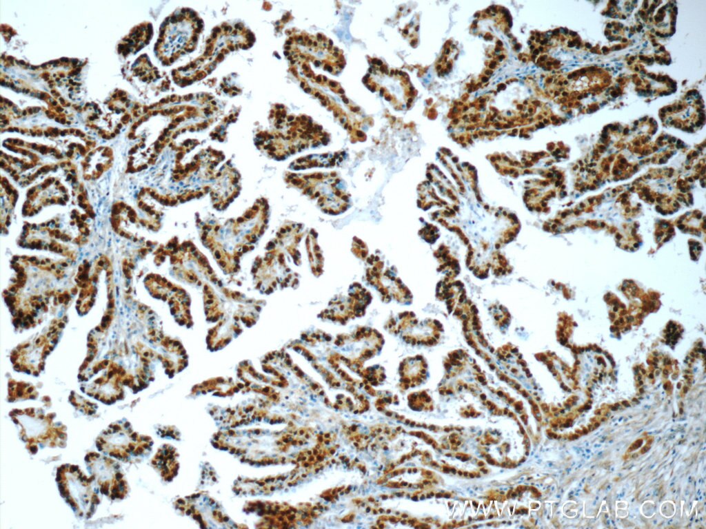 Immunohistochemistry (IHC) staining of human thyroid cancer tissue using S100A13 Polyclonal antibody (14987-1-AP)