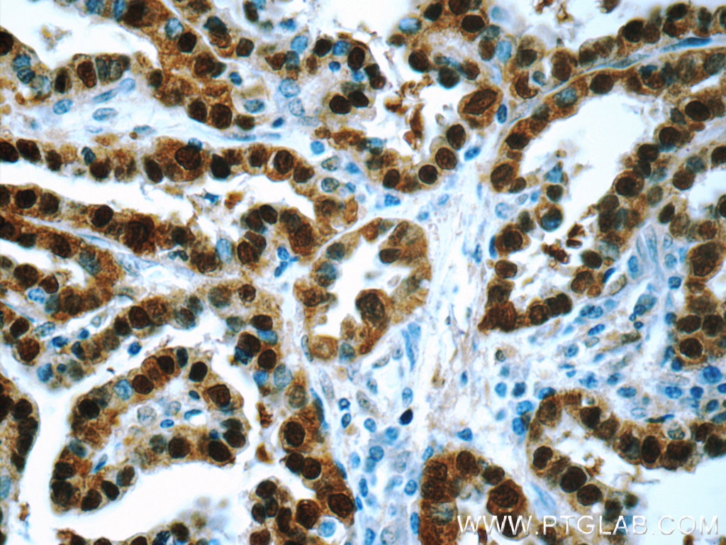 Immunohistochemistry (IHC) staining of human thyroid cancer tissue using S100A13 Polyclonal antibody (14987-1-AP)