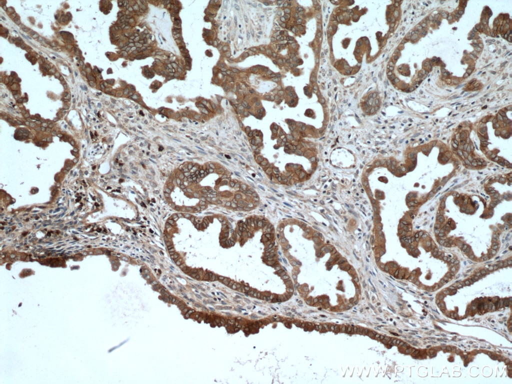 Immunohistochemistry (IHC) staining of human ovary tumor tissue using S100A14 Polyclonal antibody (10489-1-AP)