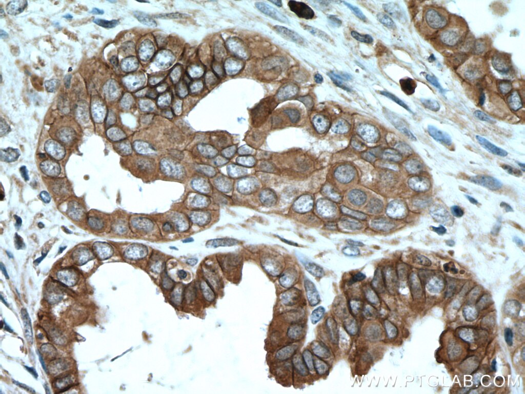 Immunohistochemistry (IHC) staining of human ovary tumor tissue using S100A14 Polyclonal antibody (10489-1-AP)