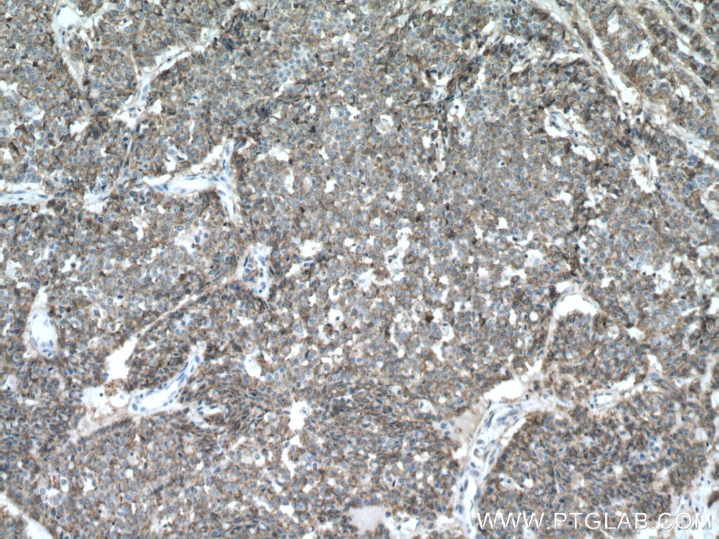 Immunohistochemistry (IHC) staining of human colon cancer tissue using S100A14 Polyclonal antibody (10489-1-AP)