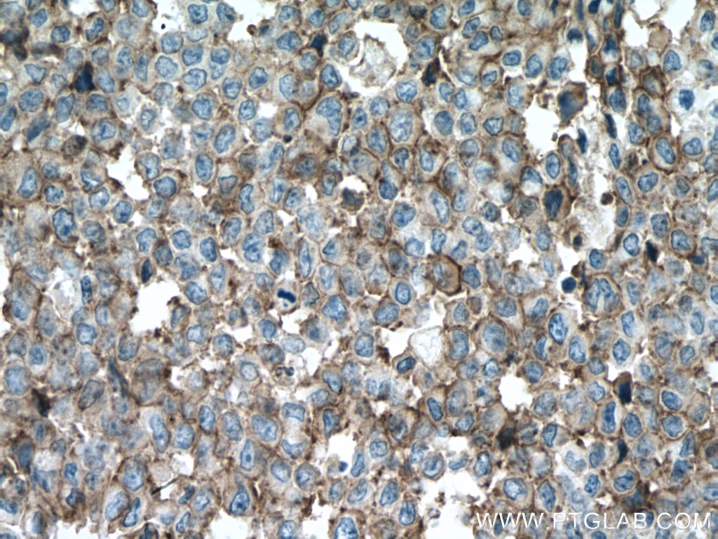 Immunohistochemistry (IHC) staining of human colon cancer tissue using S100A14 Polyclonal antibody (10489-1-AP)